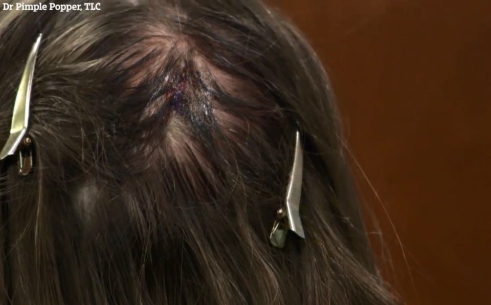  Dr Pimple Popper said it's the largest cutaneous horn she had seen