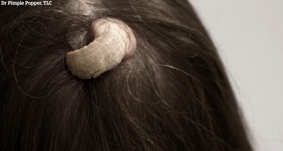  Lisa, 43, reveals the horn had been growing on her head for more than a year