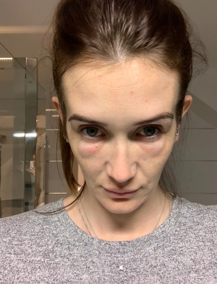 Peta says her face was so swollen it looked like she had done six rounds with Mike Tyson