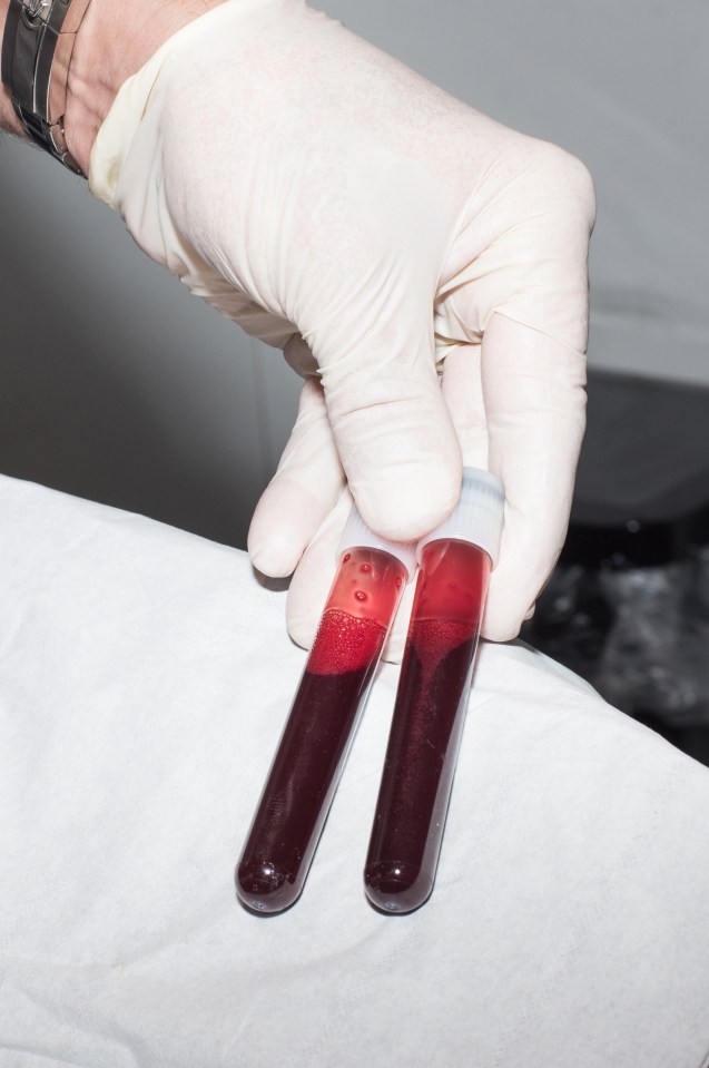  It is then spun in a centrifuge to extract platelet rich plasma