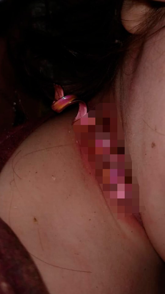  A necklace had been left on the girl for so long that it had become embedded in her skin