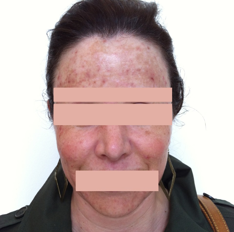  Skincare expert Renee Rouleau shared the shocking snap of a woman in her 40s whose skin has been left scarred and discoloured by years of picking