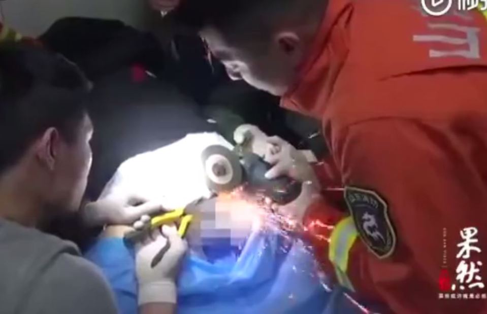  Sparks fly as rescuers get to work on the patient's nethers with a circular saw