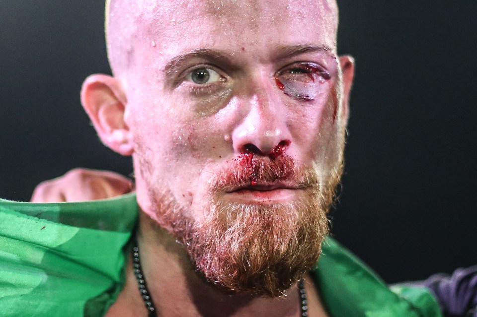  Lucas Marshall's face is bloodied and bruised after winning his gruelling fight