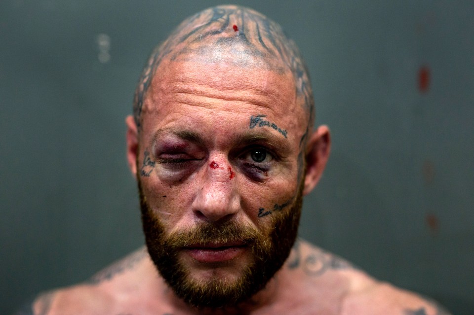  Chris Wheeldon's face is battered after his fight