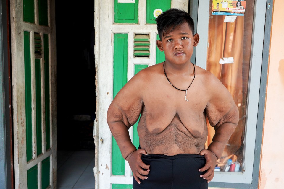  Arya Permana has been left with excess skin after losing more than 16 stone