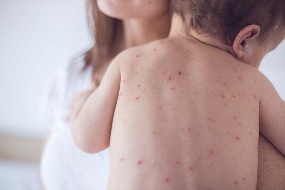  Some 285 cases of measles have been confirmed in New York since October