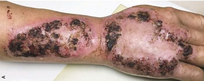 A man ended up with open sores 'eating away at his arm' after catching a fungal infection from soil