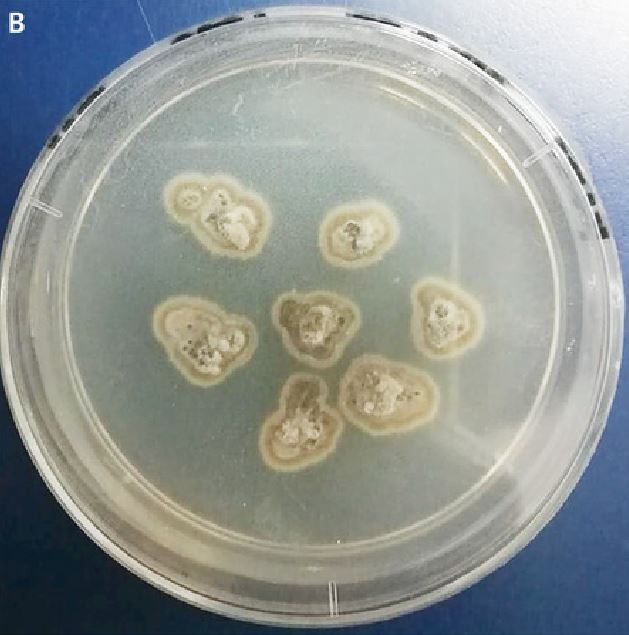 Doctors took a biopsy from their patient's arm and the fungus sporothrix schenckii started to grow - leading them to diagnose sporotrichosis