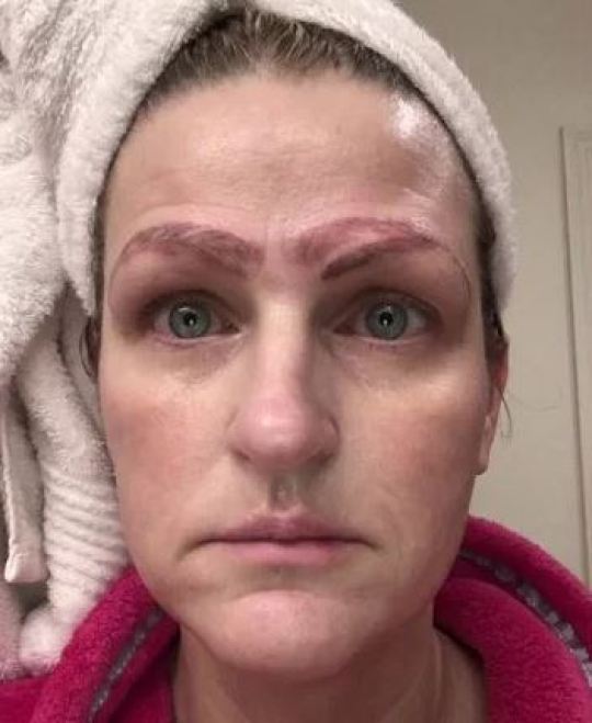  Jami Ledbetter, 42, says a botched microblading treatment left her with four eyebrows