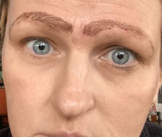  She was so appalled by the results of the cosmetic procedure she only went to work and the supermarket for fear of anyone seeing her botched brows