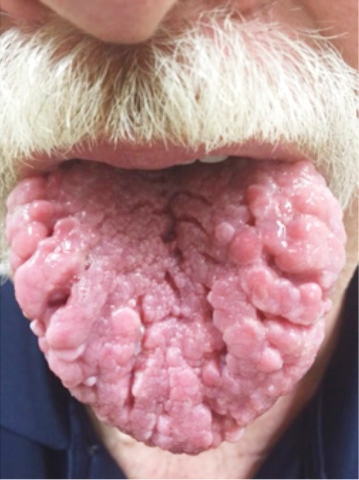 A 59-year-old man went to the doctor with multiple growths all over his tongue - which turned out to be an early sign of cancer