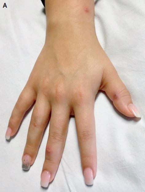  A woman was diagnosed with gonorrhoea after turning up at A&E with blisters covering her hands