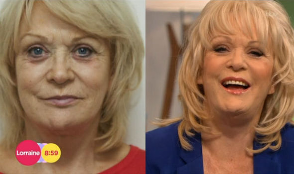 Sherrie pictured before, left, and after her first facelift