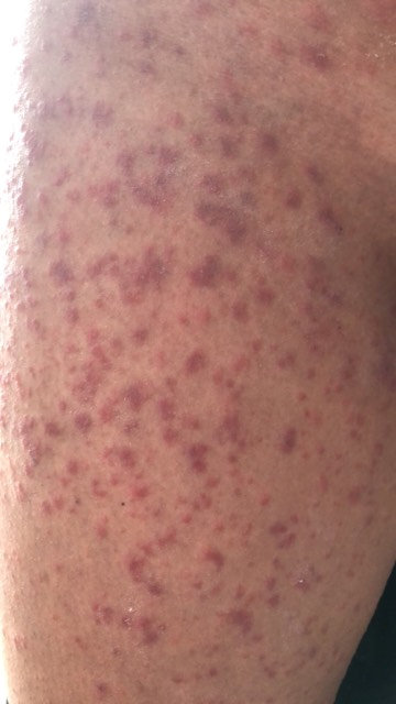  The young mum said she had taken antihistamines but still had the rash