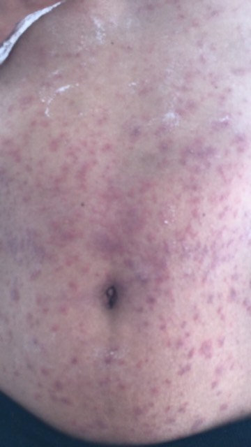  Britney said the rash looked like chicken pox