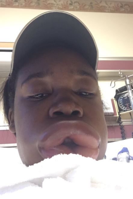  Amiyah's lips swelled up to cartoonish proportions as she hilariously live tweeted her allergic reaction