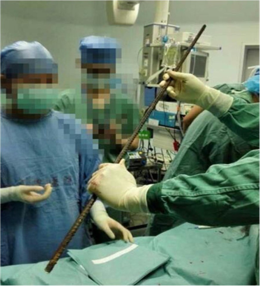 It took a team of 30 surgeons to remove the 6.5ft metal bar from the man's body