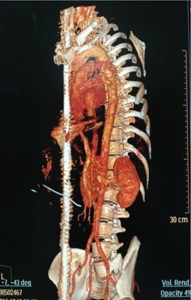 The 46-year-old man had an incredible near miss as this scan shows - the bar penetrated his scrotum, passed through abdomen, chest, neck and mouth before exiting his body on the top left side of his head