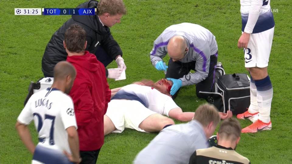  Jan Vertonghen split open his nose after a horror collision with team-mate Toby Alderweireld