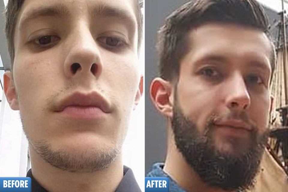  Adam Siddals underwent a drastic transformation after applying Minoxidil to his face