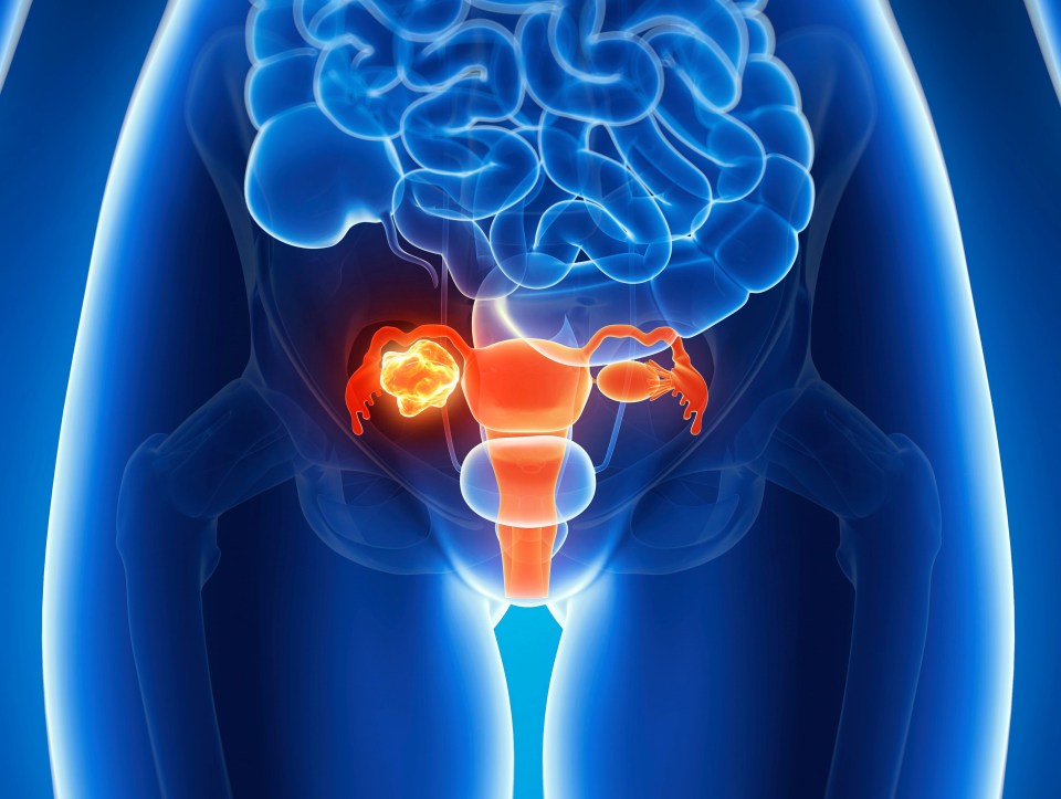 Thousands of women's lives are at risk because they're being diagnosed with ovarian cancer in the later - more advanced - stages, a charity has warned