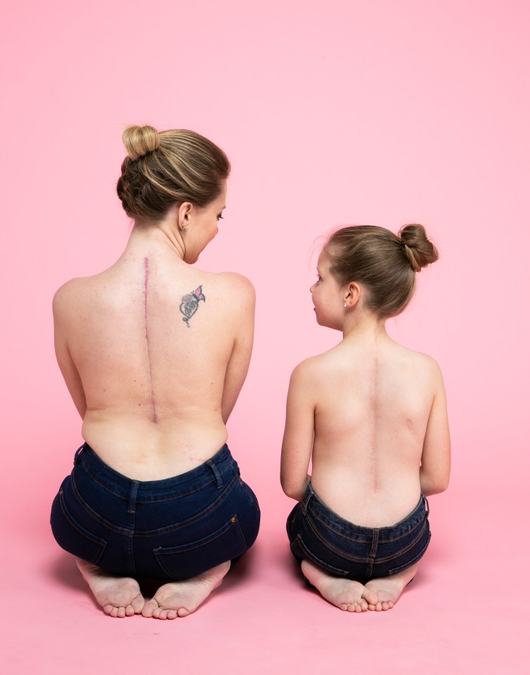  Mother and daughter now proudly show off their scars together