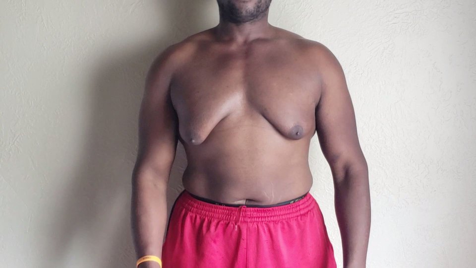  He suffers from a condition which has caused his breast tissue to grow bigger than usual