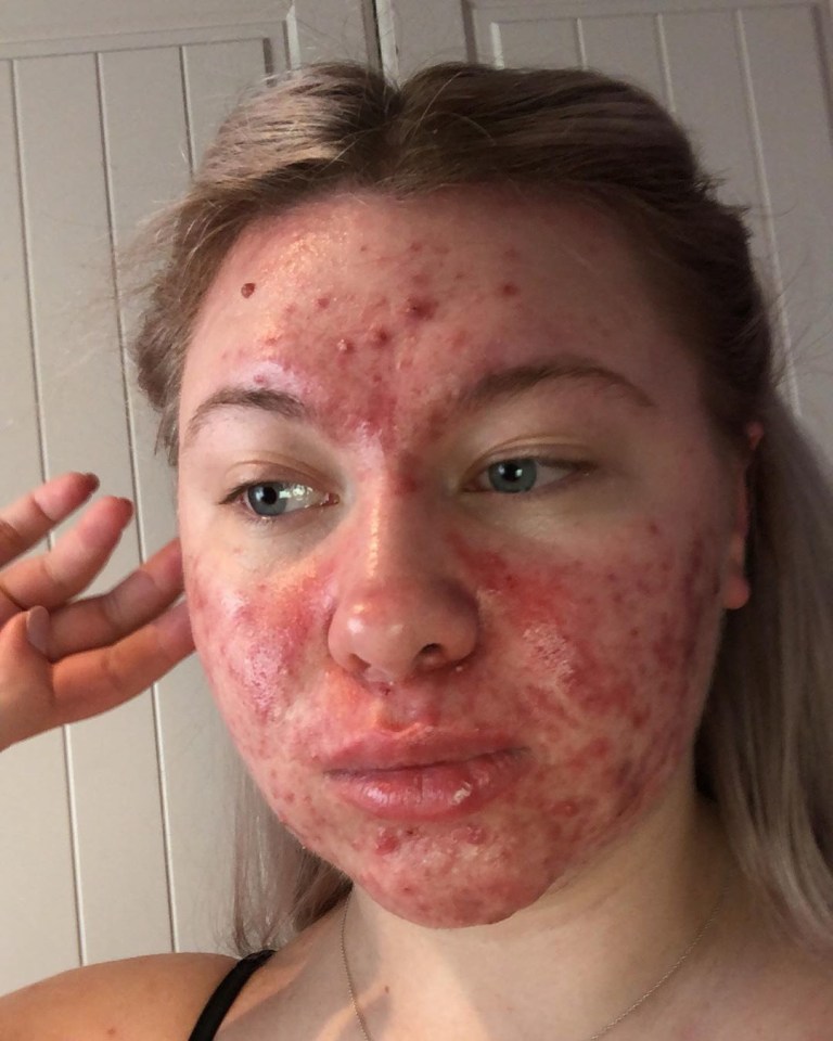  Abigail Collins, 19, has suffered with spots since the age of 10