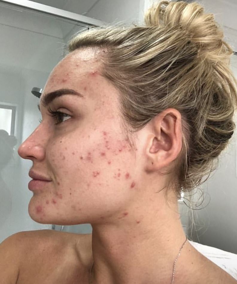 Georgie Stevenson went ‘through hell and back’ after two bouts of adult acne left her with terrible scarring