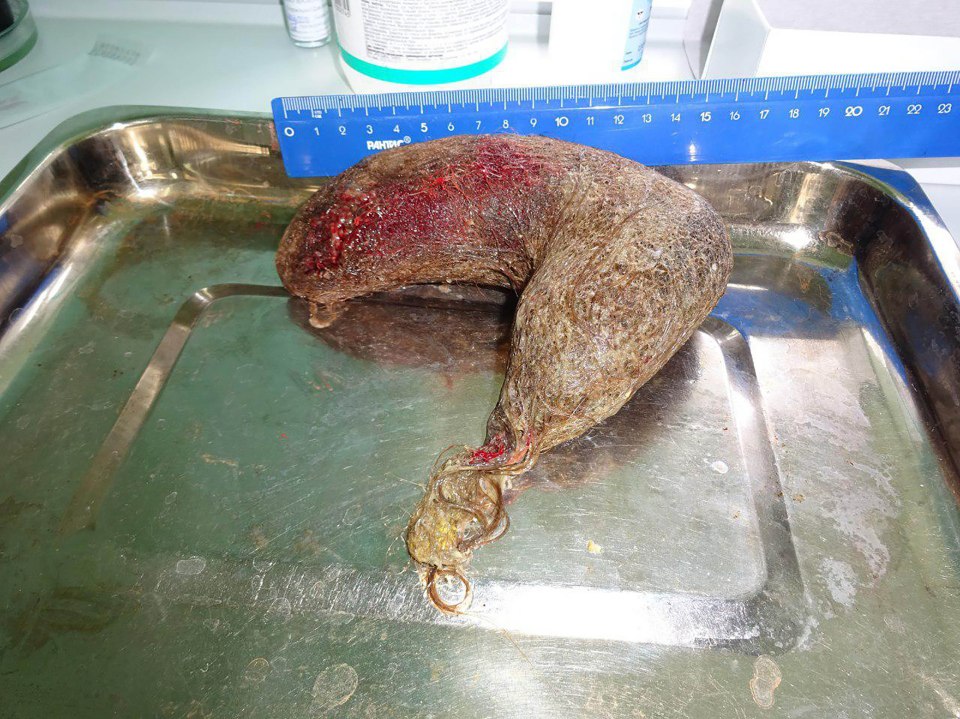 This huge clump of hair was removed from a 16-year-old girl's stomach after chewing on her locks for 10 years