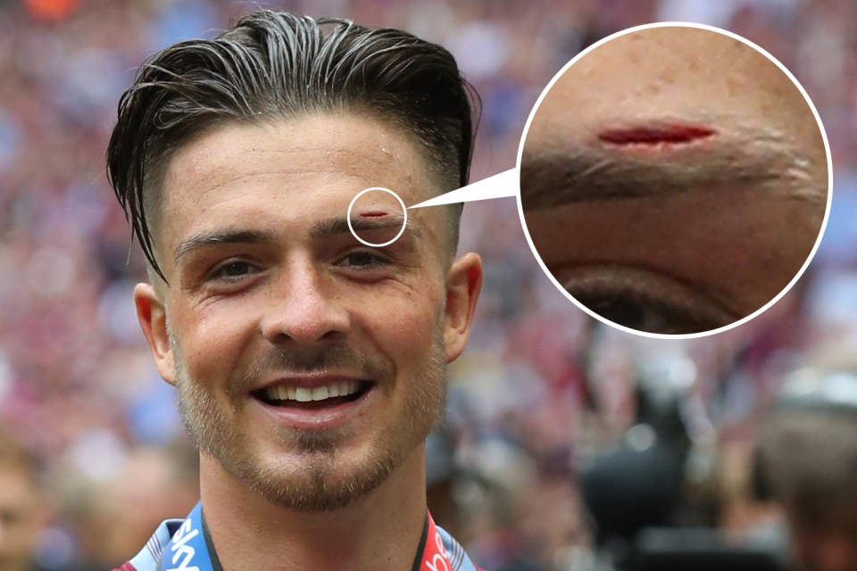  The nasty gash can be seen above Grealish's left eye after the accident