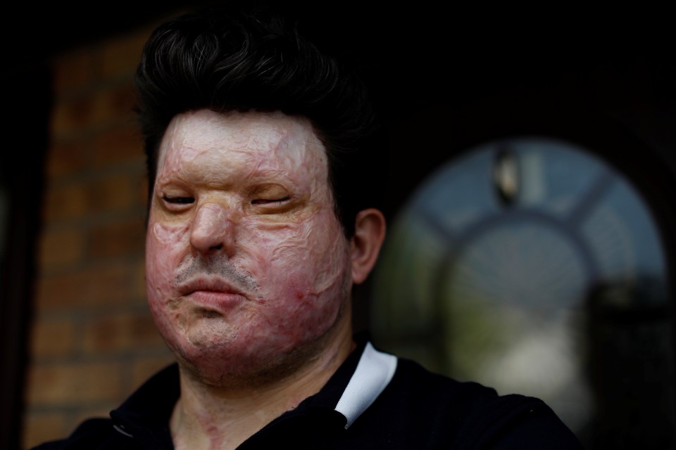 Acid attack victim Andreas Christopheros called her comments ‘reckless and deeply stupid’