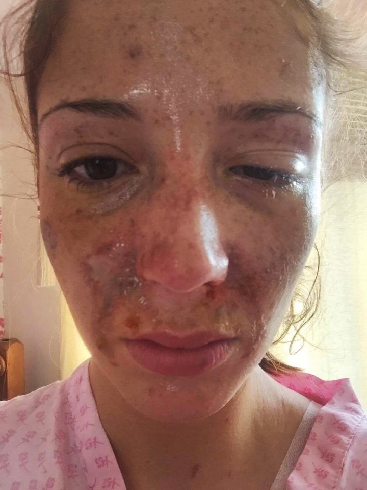 Sophie Hall pictured the day after she was attacked by Arthur Collins