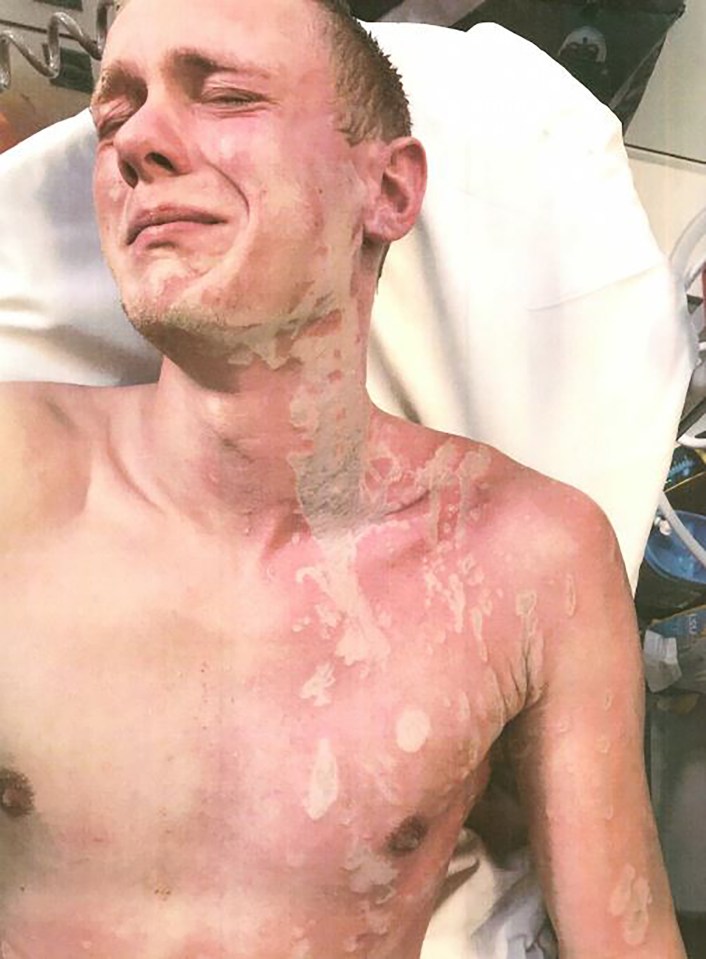 He suffered second and third degree burns across his face and body