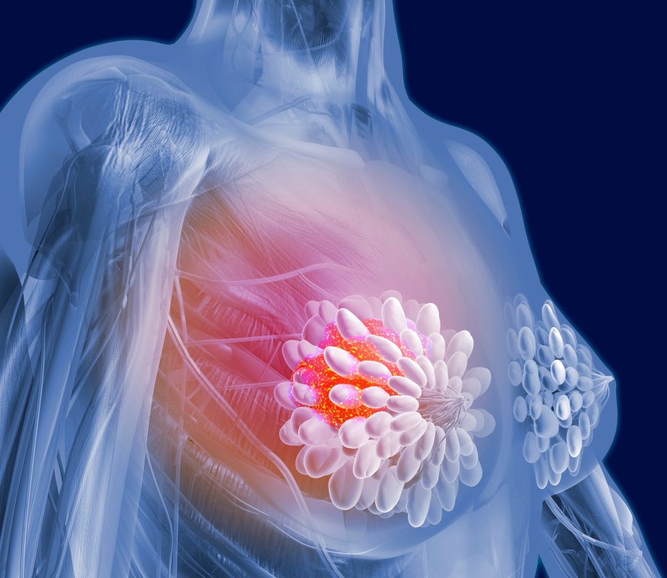  Breast cancer drug which blocks proteins that feed tumour growth has been proven to boost survival in pre-menopausal women