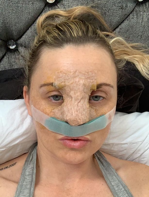  Carla had a nose job on the NHS in February after faking mental health issues