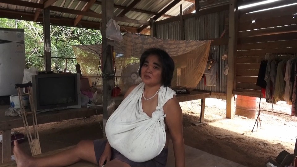  Lamphrai Srinuan, 46, first noticed her breasts swelling three years ago but thought nothing more of it