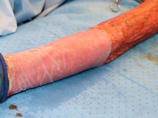  Out of that one graft, docs managed to get over 20 pieces of skin to cover 50pc of Glenn's body