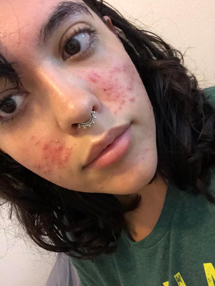  This was the woman's spot-ridden complexion just nine days ago