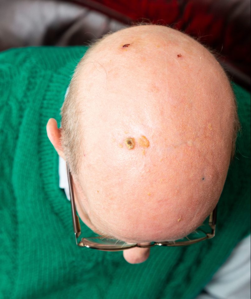  Roy,77, was hit so hard on the head by one of the gulls that he needed hospital treatment