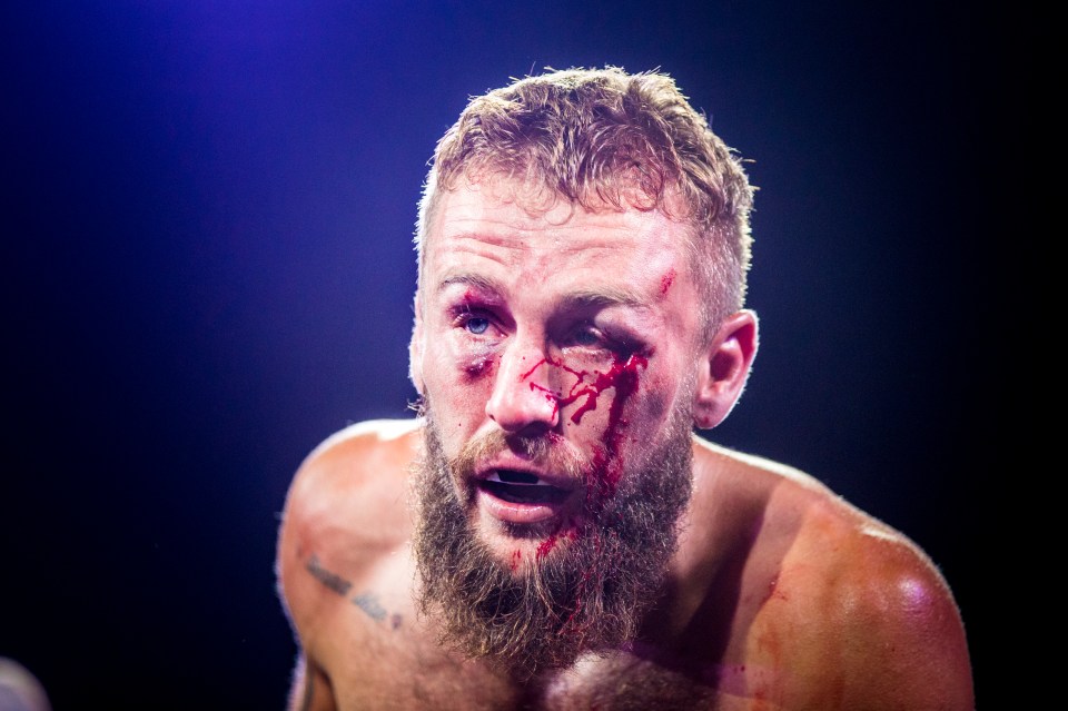  A fighter is left bloody and bruised after losing a fight