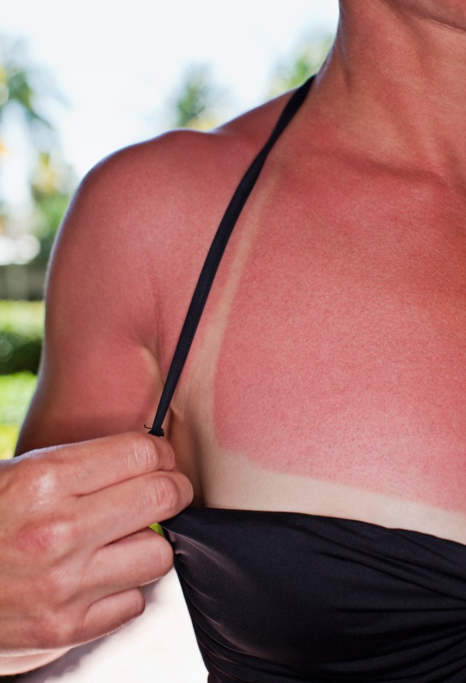 White women who get five or more severe sunburns in their teens have double the risk of developing melanoma