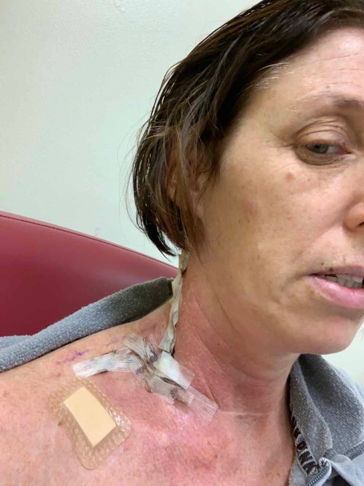  Six years later, Sarah spotted another similar mole and again tests revealed it was melanoma - this time stage three, and had spread to her lymph nodes