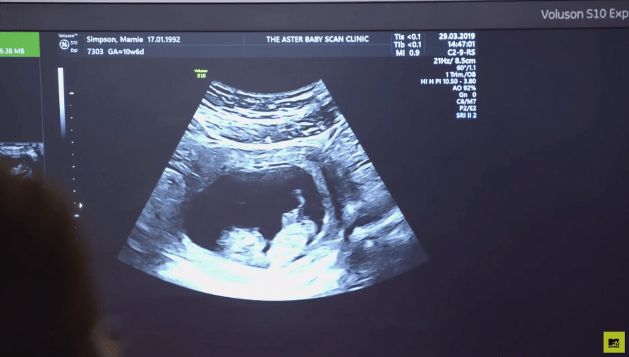  The scan was the first time that she had seen her unborn child