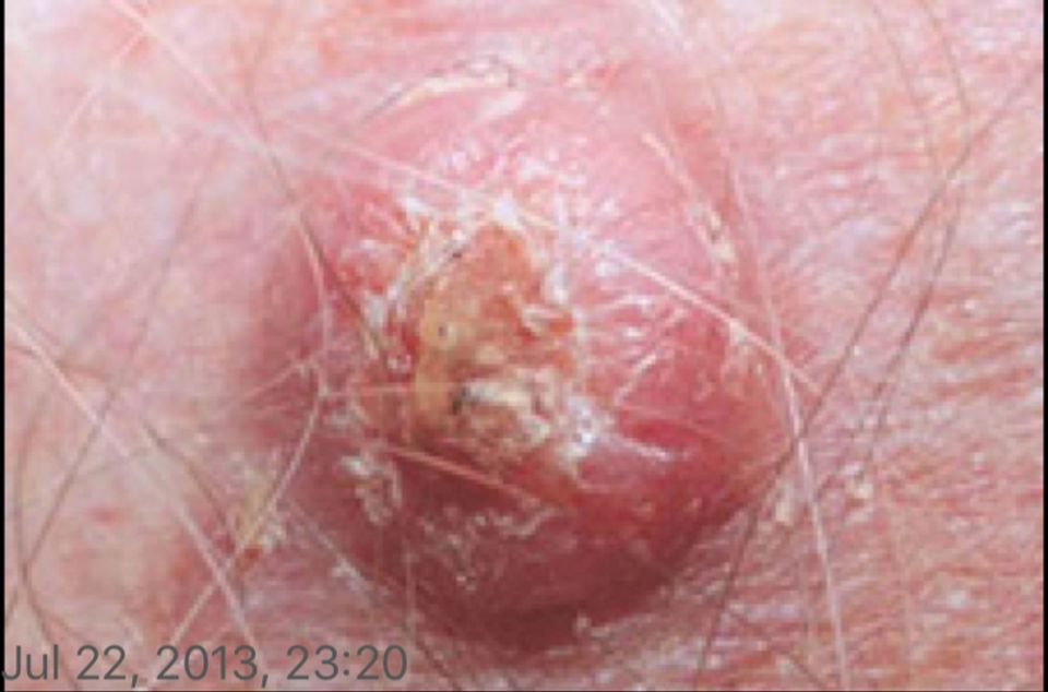  Her skin cancer started out as a small wart-like lump