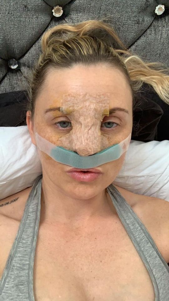  Carla, 37, got her nose job on the NHS after pretending to have mental health problems