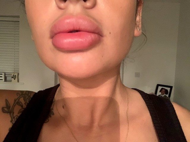 The single mum, who suffers with body dysmorphia, has admitted to messing up her lips