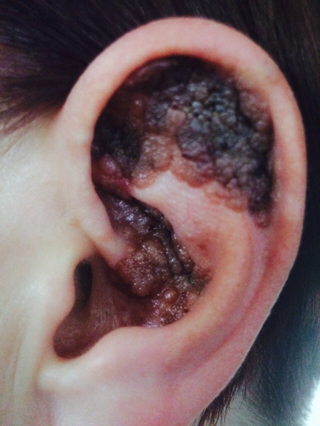  Anthea was forced to have her ear amputated after developing a deadly skin cancer