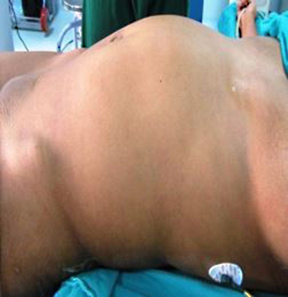  The teenager's stomach was swollen and the lump was found to be hard and firm to the touch